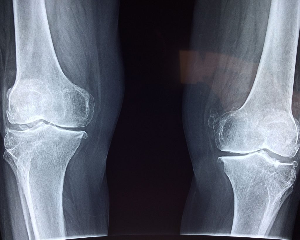 An x-ray of a pair of knees.